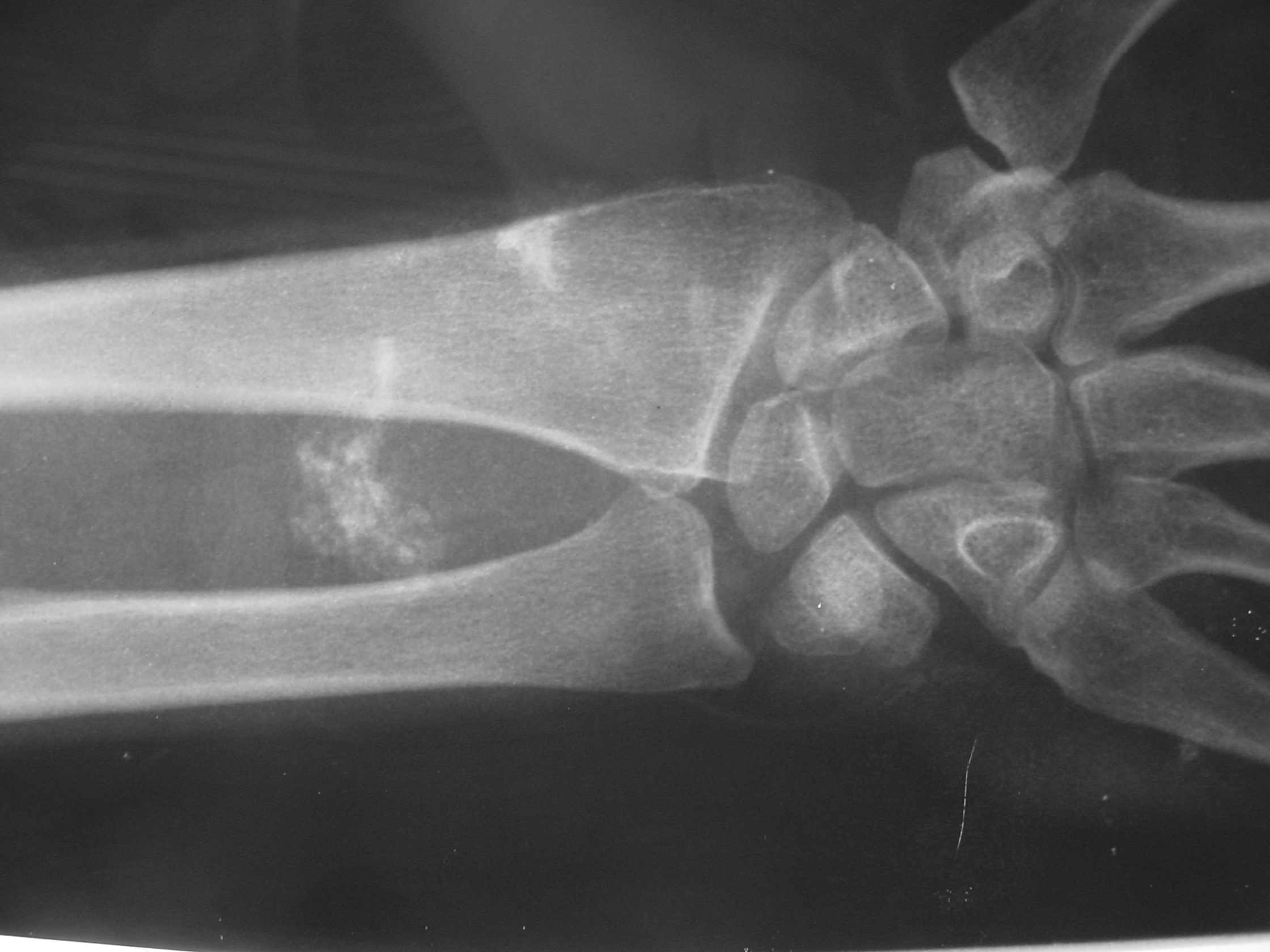 ewing-sarcoma-of-the-chest-wall-large-extrapulmonary-invasive